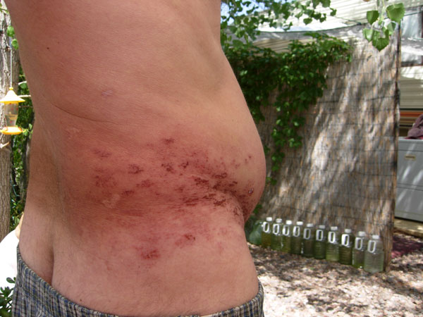 shingles